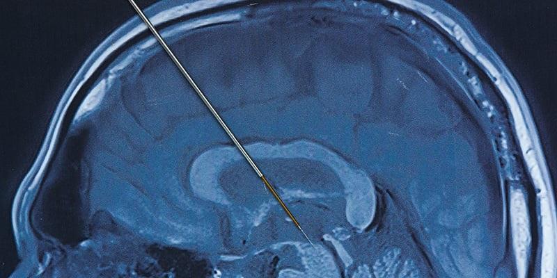 A side view of a brain X-ray with a pointer showing where electrode are placed.